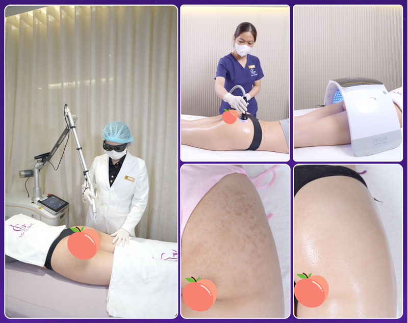 Trị thâm mông hiệu quả bằng công nghệ Deep L-Picosure tại LG Clinic